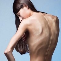Anorexia: Causas, Sintomas e Tratamento