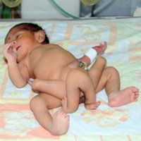 Bebê de Seis Pernas Passa por Cirurgia no Paquistão