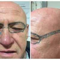 Homem Bebe Demais e Acorda com Óculos Tatuado na Cara
