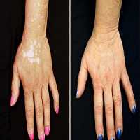 Medicamento Ã© Capaz de Trazer Pigmento da Pele de Volta a Pessoas com Vitiligo