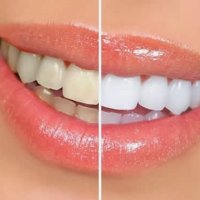 O Quanto Ã‰ Seguro o Clareamento dos Dentes?