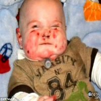 Bebê Sofre de uma Rara Doença, na Qual Qualquer Toque Deixa sua Pele com Bolhas e Cicatrizes