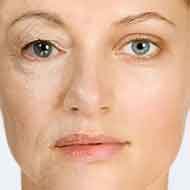 Envelhecimento Precoce vs. Botox