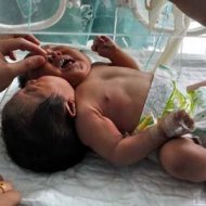 Bebê Nasce com 2 Cabeças na China